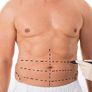 Male Aesthetics - Liposuction